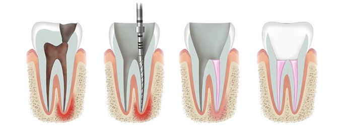 What Is A Root Canal